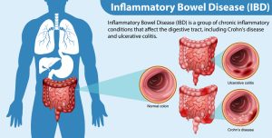 Inflammatory Bowel Disease (IBD) Infographic illustration